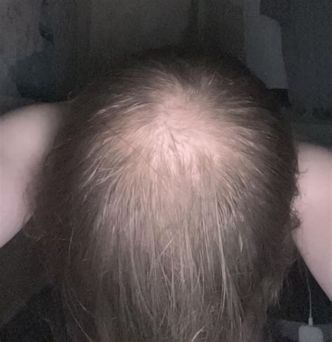 3 months progress fin/min + dermarolling (before and after .